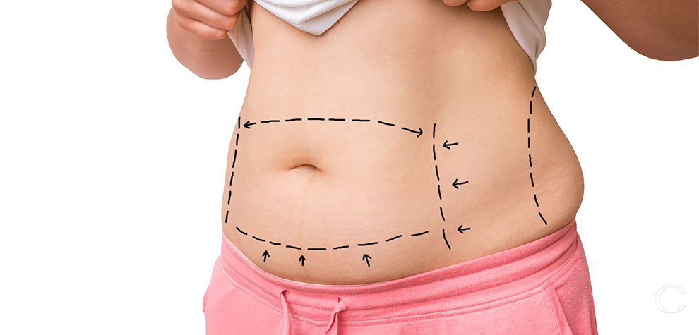 cosmetica panniculectomy vs tummy tuck