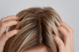 woman with dandruff